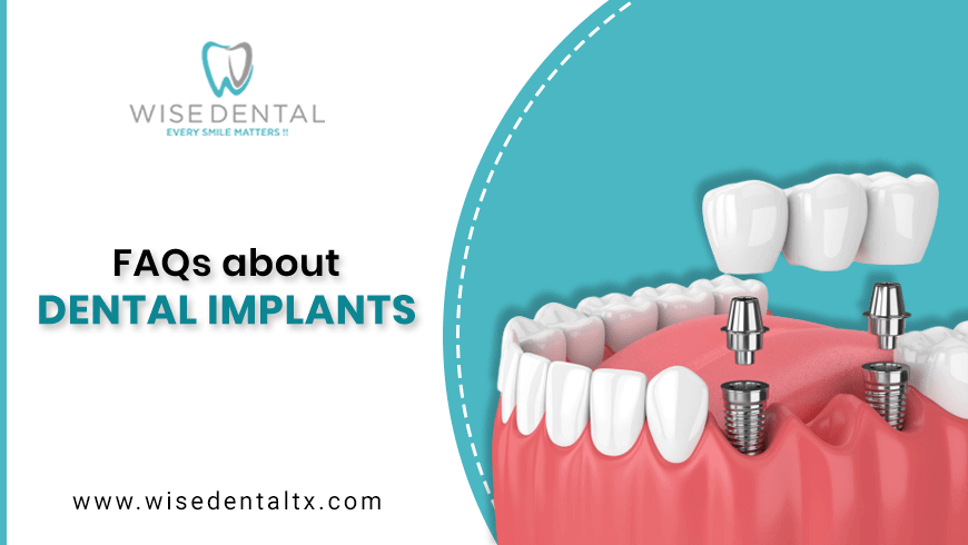 FAQs about Dental Implants
