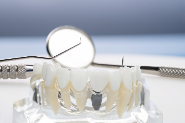 dental-implants