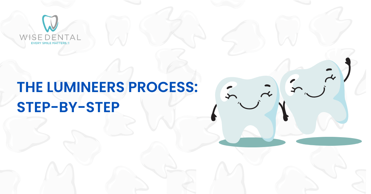 The Lumineers Process StepByStep Guide by Wise Dental