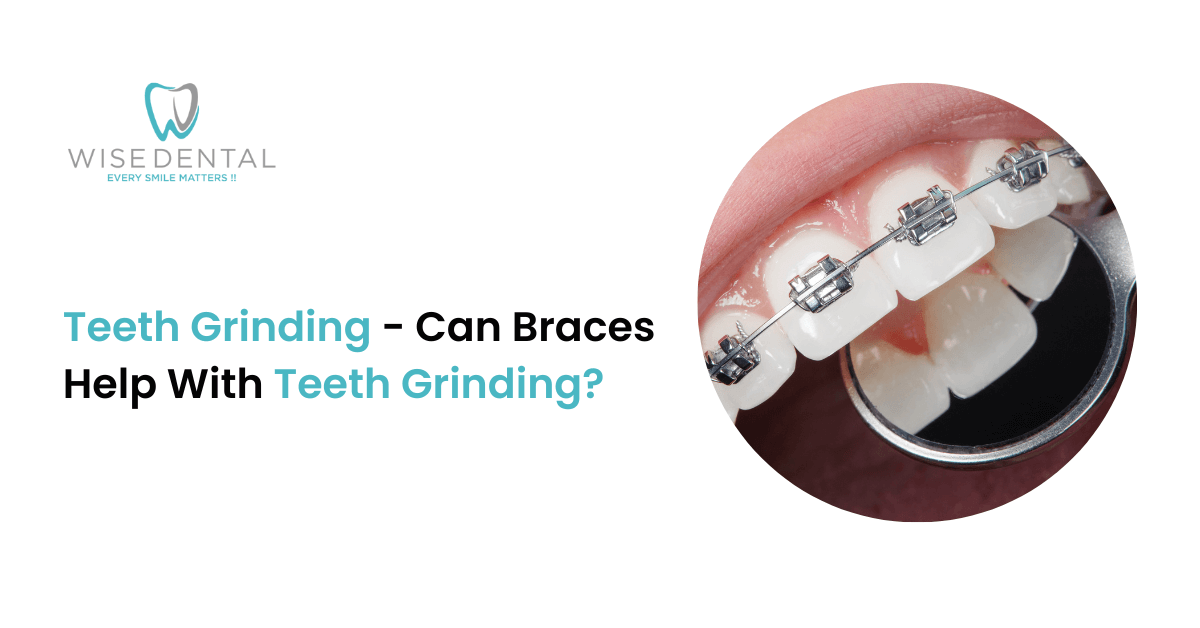 Teeth Grinding Can Braces Help With Teeth Grinding Wise Dental